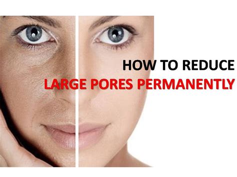 how to reduce pores permanently.